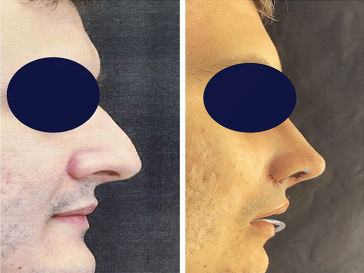 Lucas-antes-e-depois-2-2.png